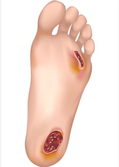 Preventive podiatry and foot care image